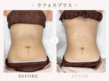 パールプラス 伊勢店(Pearl plus)/ぽっこりお腹/くびれにも◎