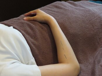 じゃぱん鍼灸りらく院 整骨院/施術中