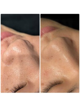 トリニティスペース(TrinitySpace)/メンズ鼻だけハーブピーリング