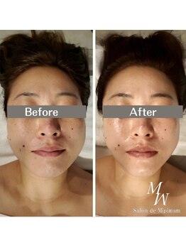 ミピマムマール(Mipimam Maaru)/お客様before→after