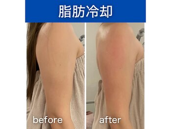 シアラ(SHIARA)/脂肪冷却１回の変化