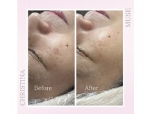 シャルムパリス(charme paris)/老けない肌へ♪１回の変化