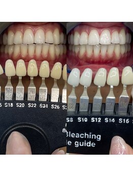 トウキョースワーズ 渋谷店(TOKYO SWRS)/#ホワイトニング #渋谷 #池袋