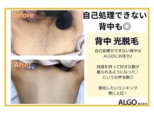 アルゴ 山口宇部店(ALGO)/背中脱毛開始前→10回目！