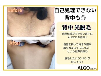 アルゴ 山口宇部店(ALGO)/背中脱毛開始前→10回目！