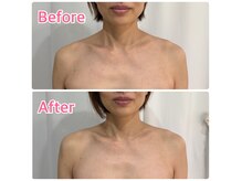 レスピロン(Respirons)の雰囲気（インディバで韓国肩に。首肩こりも同時にケア。↑施術１回の効果）