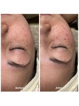 ゆりの花/シミケアした後