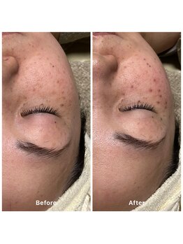 ゆりの花/シミケアした後