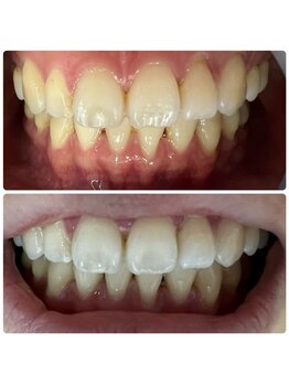 ラブホワイトニング 渋谷店(LOVEホワイトニング)/初回2回照射ホワイトニング