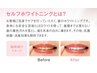 セルフホワイトニング《ネイル割》無料でワンランクアップ