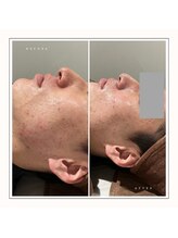 ディアー(Dear)/陶肌トリートメント