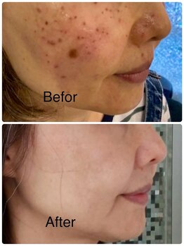 しみ改善サロン リフィーナ/傷にならずメイクもOK♪