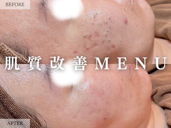 レヴェリー 心斎橋店(REVERIE)/‐ ハーブピーリングB&A ‐