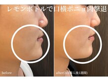 ハティア(hattia)の雰囲気（韓国発！最先端の脂肪分解溶剤レモンボトル♪小顔/痩身/たるみ）