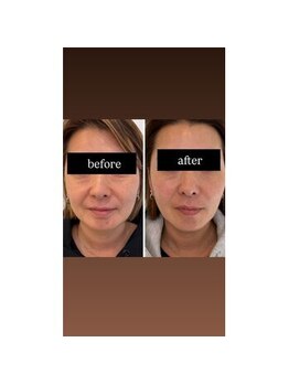 ローゼ(ROSE)/【リフトアップ】【ほうれい線】