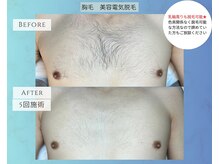 ハエン(HAEN)/胸　マイクロニードル脱毛