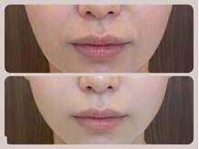 ドクターリバース(Dr.Reverse)/【フェイシャル】美肌&小顔に♪