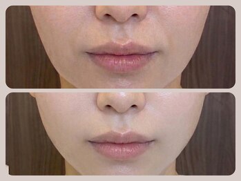 ドクターリバース(Dr.Reverse)/【フェイシャル】美肌&小顔に♪