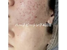 カピリナ(KA PILINA)の雰囲気（韓国式ハーブピーリング！肌が生まれ変わります！）