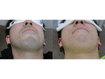 ラグジー 本八幡店(LUXY)/どんな剛毛の方でもご相談下さい