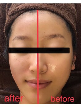 ミント(M’int)/むくみ、頬骨の開き