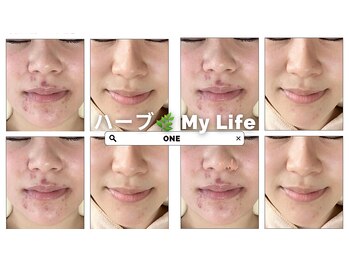 ワン(ONE)/ハーブピーリング