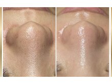 アイスリー(i III)/