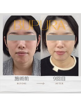 ブプラ 光の森店(BUPURA)/お客様ビフォーアフター