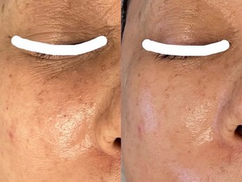 ビーフリー(Be free)/ハーブピーリングで艶肌に