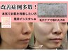 シミ改善ケア【ニキビや肌荒れによる跡、色素、毛穴が気になる】13,200円⇒