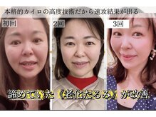 サロンチオリ 烏丸(Salon Chiori)/長年のほうれい線改善で理想の肌
