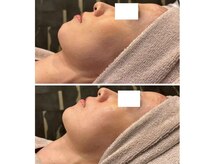 ビュウナ 銀座(BEAUNA)/マルチウェーブリフト