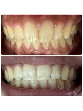 ラブホワイトニング 渋谷店(LOVEホワイトニング)/初回３回照射ホワイトニング