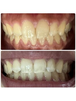 ラブホワイトニング 渋谷店(LOVEホワイトニング)/初回3回照射ホワイトニング