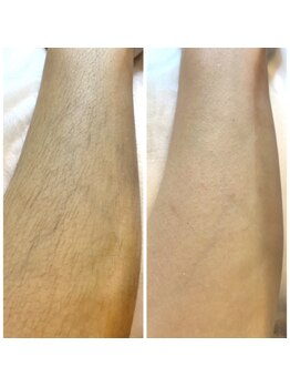 アロー(Allo!)/肘下WAX脱毛Before/After