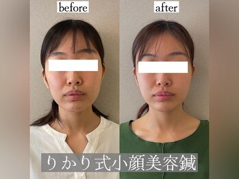 りかり 明石大久保院/小顔&トーンアップ!!