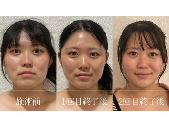 ロータス ビューティー(LOTUS Beauty)/小顔/エラ張り改善