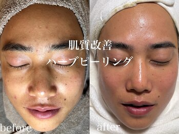 ネオリー(neorii)/肌質改善　ハーブピーリング