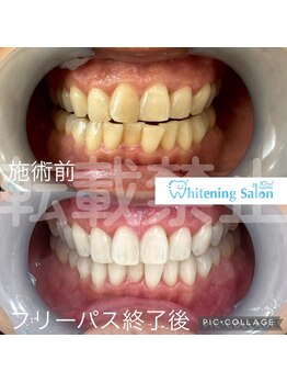 ホワイトニングサロン 名古屋 栄店/【ホワイトニング】