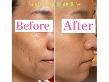 トータルビューティーサロン 凛/周りから褒められる肌