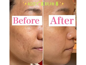 トータルビューティーサロン 凛/周りから褒められる肌