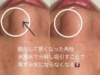 ココモンド(COCOMONDO)/ハイドロ毛穴洗浄/毛穴/毛穴洗浄