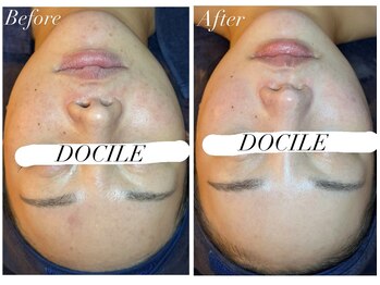 ドシル(DOCILE)/1ヶ月での変化です！