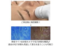 ステラ(Stella)/毛穴撮影