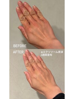アンテグラール/【手元ケア、エクソソーム導入】