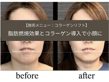 デスティン(DESTIN)/毛穴・小顔フェイシャル
