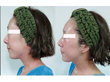 ソフィーム/エンビロンリフトフェイシャル