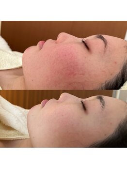 エステサロン ココルタン 薬院(Coco Le Temps)/リミーエコツーペースト1回