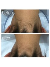 ナチュラル シャイン(NATURAL SHINE)/うなじ脱毛