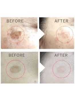 プランス 博多店(PLANCE)/博多 エステ シミケア